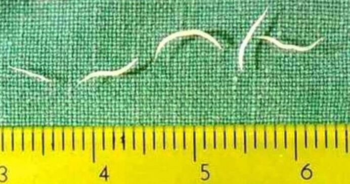 Pinworms yosh bolalarda eng ko'p uchraydigan gijja turidir. 