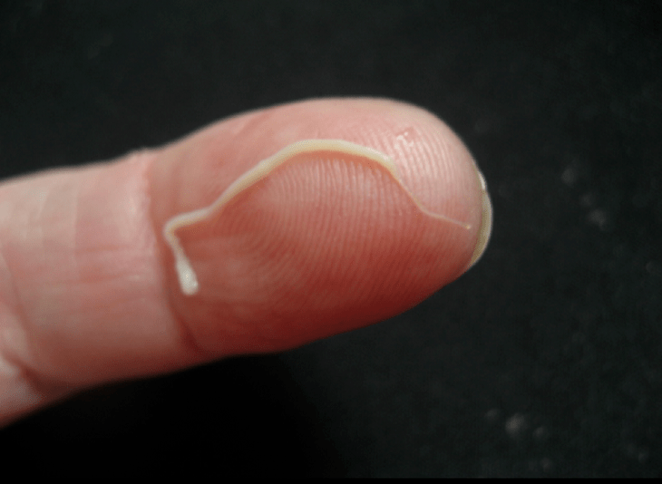 inson tanasidagi aylanma qurt parazit